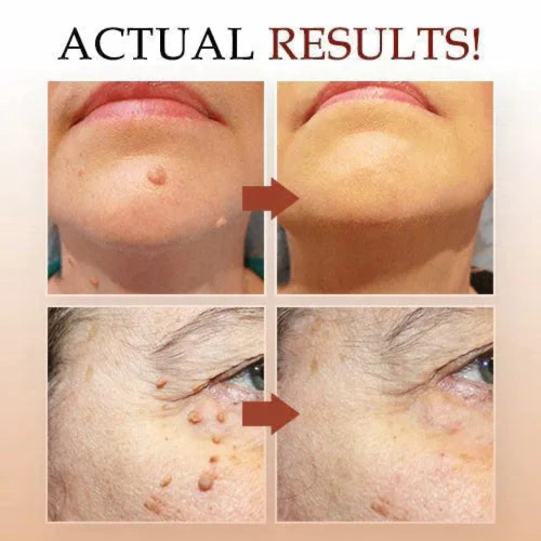 Wart Remover Cream - All Natural Way - Painless & Non Surgical