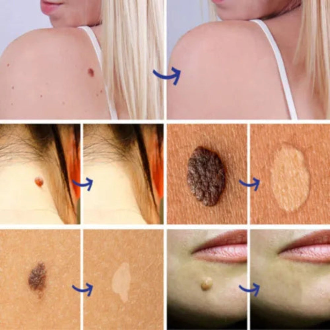 Wart Remover Cream - All Natural Way - Painless & Non Surgical