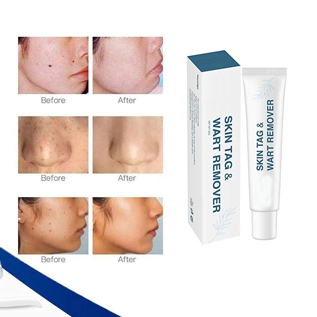 Wart Remover Cream - All Natural Way - Painless & Non Surgical