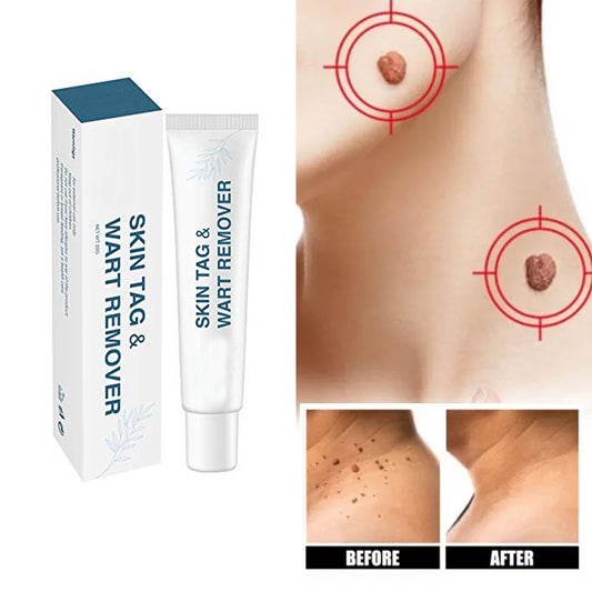 Wart Remover Cream - All Natural Way - Painless & Non Surgical